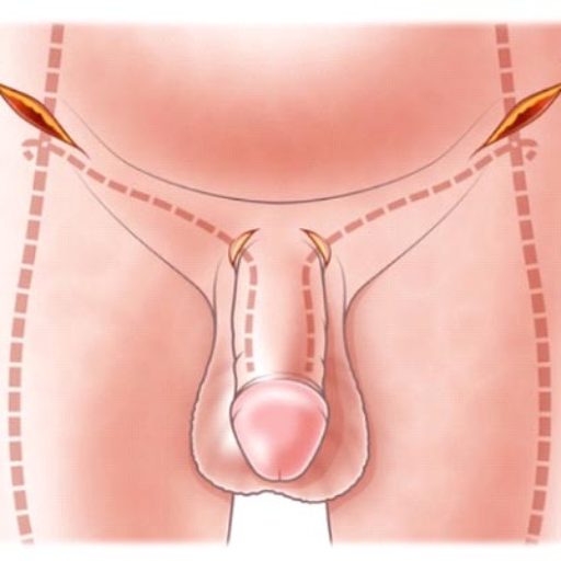 Post Prostatectomy Erectile Dysfunction Southern Plastic